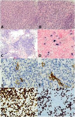 Case Report: Identification of a novel STAT3 mutation in EBV-positive inflammatory follicular dendritic cell sarcoma